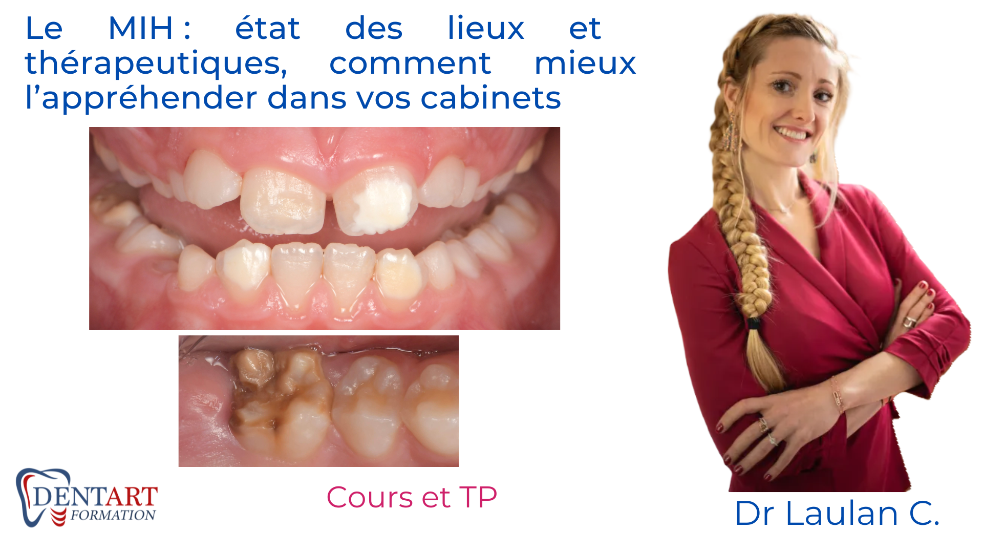 MIH hypominéralisation incisive et molaire Tâches blanche dentiste esthétique travaux pratiques