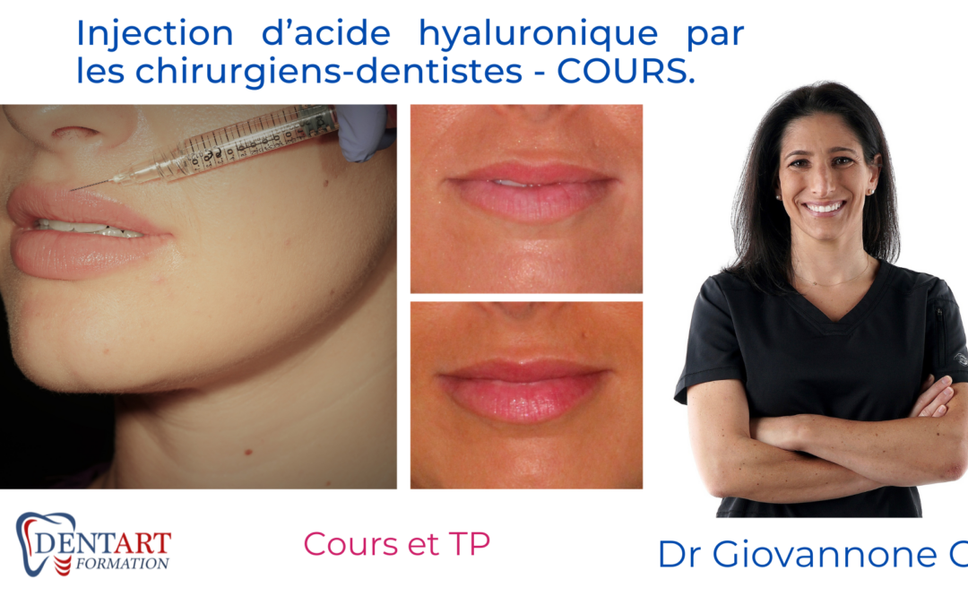 Injection d’Acide Hyaluronique par les chirurgiens-dentistes – COURS