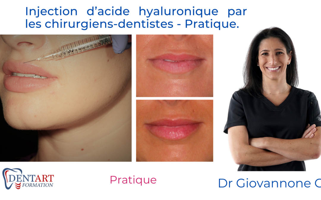 Injection d’Acide Hyaluronique par les chirurgiens-dentistes – PRATIQUE